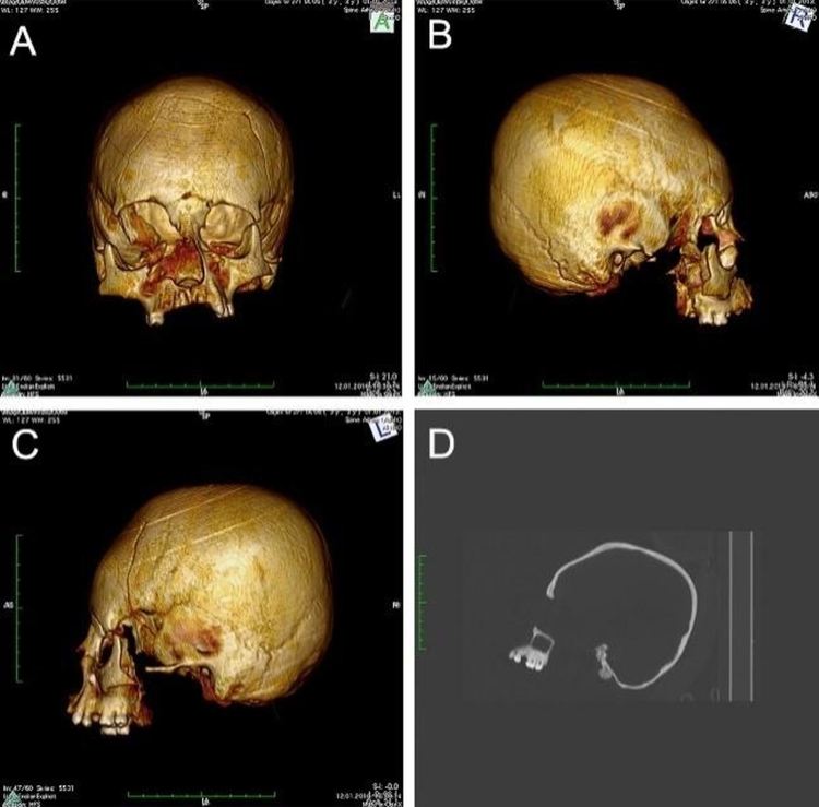 Откриха древни скелети със странно деформирани черепи в Хърватия